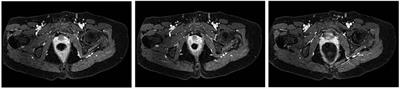 Colorectal infiltrating deep endometriosis: Laparoscopic treatment. A case report